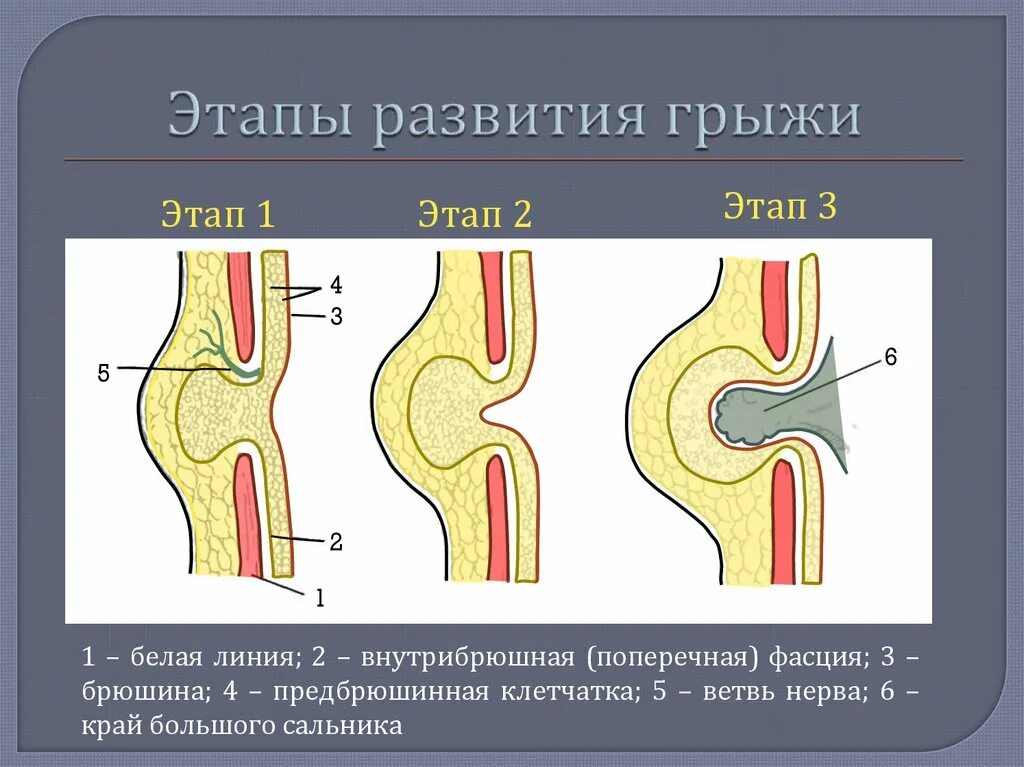 Поперечное 1 степени. Предбрюшинная липома белой линии живота. Вправимая грыжа белой линии живота. Стадии развития грыжи белой линии.