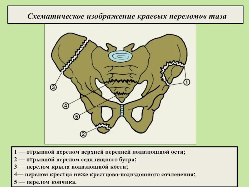 Передние ости подвздошных костей. Крыло подвздошной кости перелом. Перелом крыла подвздошной кости таза. Отрывной перелом передней верхней ости подвздошной кости. Краевой перелом подвздошной кости таза.