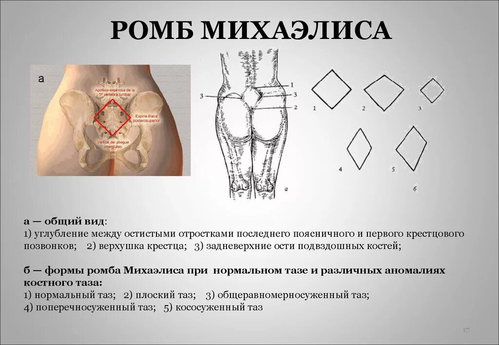 Ромб Михаэлиса норма у беременных. Исследование ромба Михаэлиса. Ромб Михаэлиса Размеры в норме. Размер ромба Михаэлиса 9*9. Расширение таза при беременности