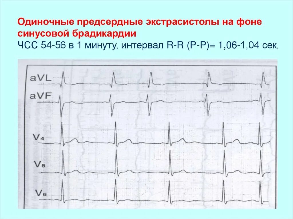 Предсердная экстрасистолия на ЭКГ. Предсердные экстрасистолы на ЭКГ. Интервалы ЭКГ экстрасистола. Одиночная предсердная экстрасистола на ЭКГ. Экстрасистолы в минуту