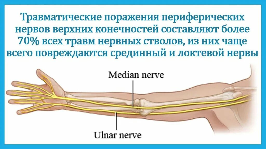 Повреждение локтевого нерва. Поражение срединного нерва симптомы. Защемление лучевого нерва. Туннельный синдром локтевого нерва рентген. Туннельный синдром локтевого нерва.