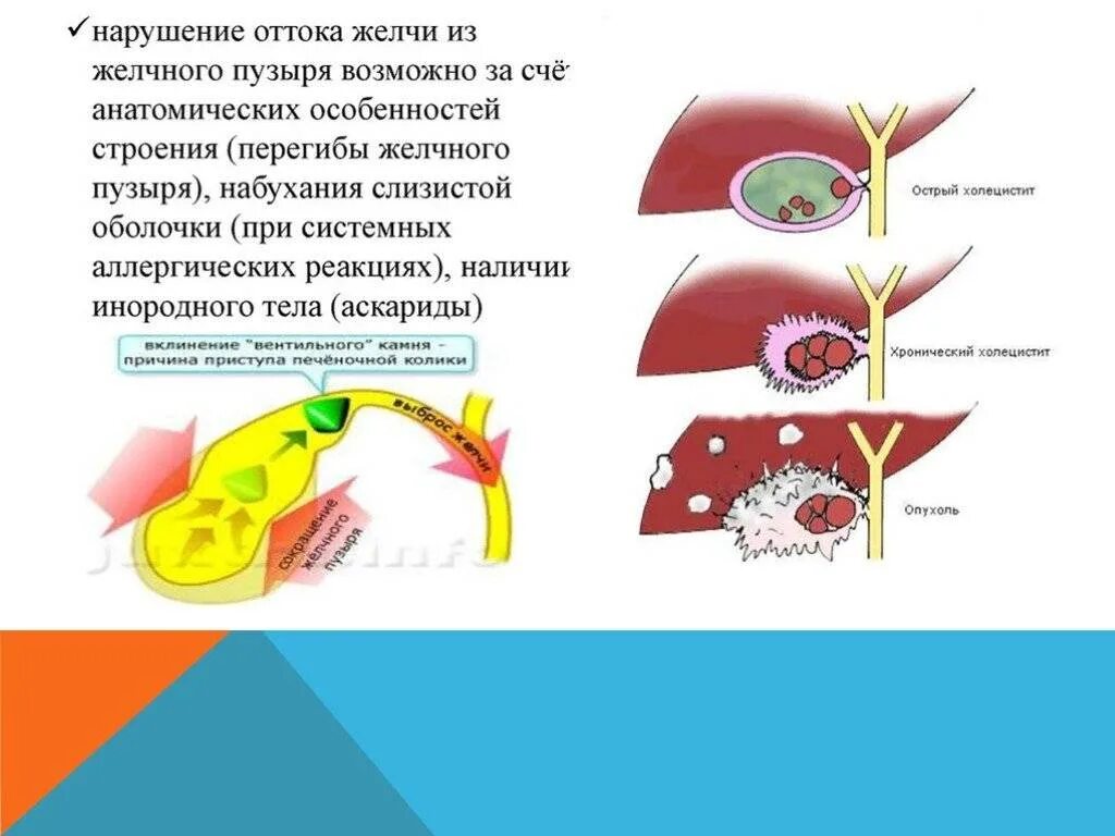 Улучшение желчеоттока. Нарушение оттока желчи. Отток желчи из желчного пузыря. Желчный пузырь отток желчи. Упражнения улучшающие отток желчи из желчного пузыря.