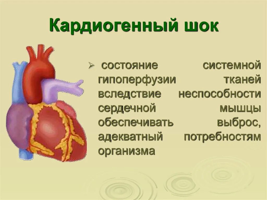 Кардиогенный ШОК. Кардиогенный ШОК картинки. Кардиогенный ШОК сердце. Кардиогенный шок наиболее часто