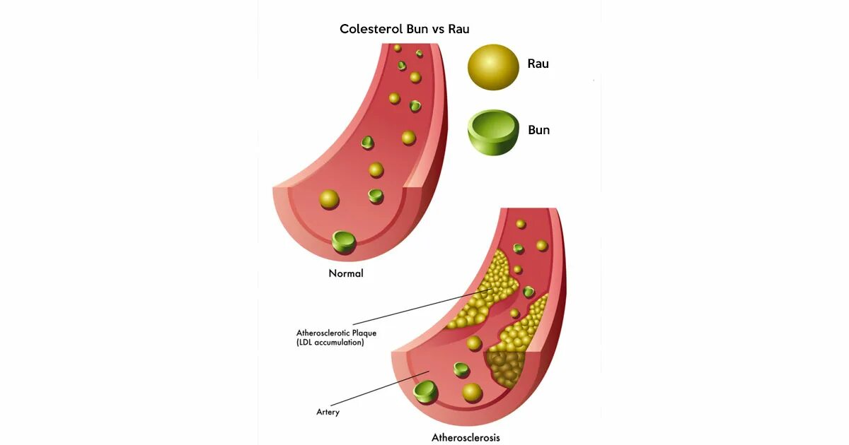 Холестерин. Плохой холестерин. Хороший холестерин. Холестерин в крови.
