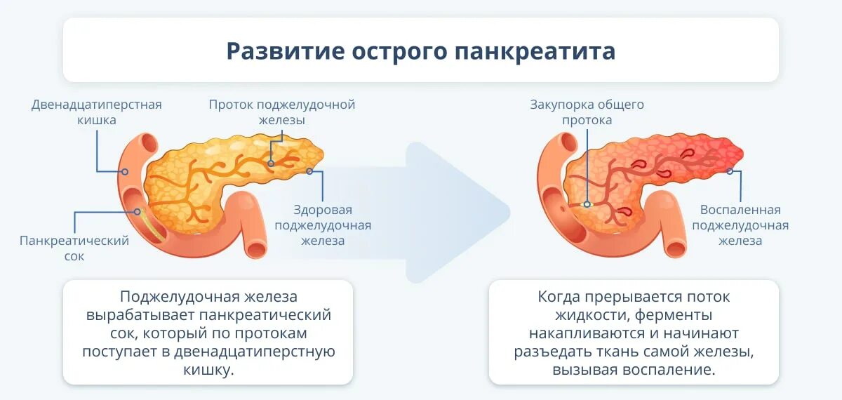 Задачи панкреатит. Панкреатит и холецистит. Панкреатит причины. Ферменты при панкреатите. Препараты при остром панкреатите.