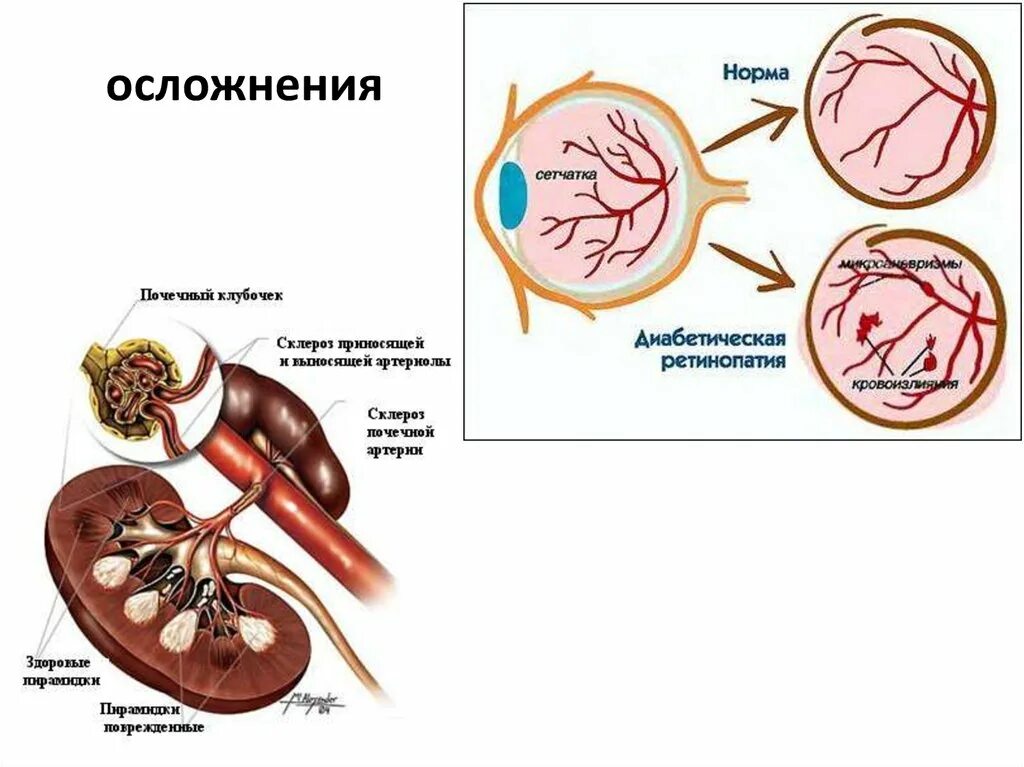 Склероз клубочков в почках. ЛФК при заболевании внутренних органов. Осложнения картинка