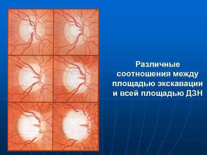 Глазное дно экскавация. Глаукоматозная экскавация диска зрительного нерва окт. Глаукоматозная экскавация зрительного нерва. Глаукомная экскавация зрительного нерва. Экскавация дзн.