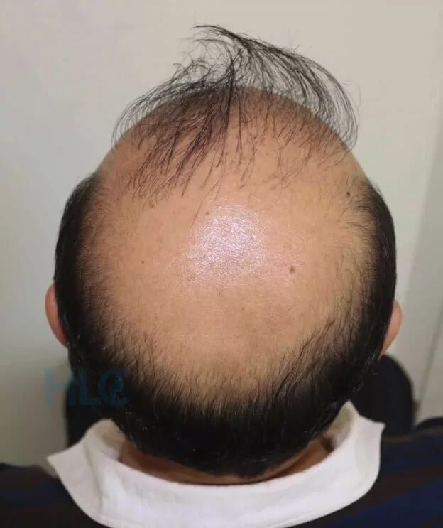 лысина сверху
