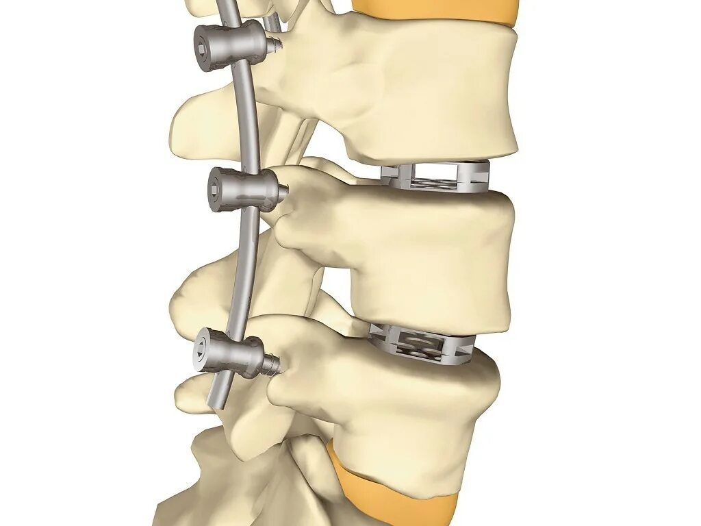 Транспедикулярная фиксация th11 th12- l2 l3. Спондилодез поясничного отдела. Межпозвоночный Кейдж l5s1. Транспедикулярная фиксация позвоночника l5-s1. Операция на позвоночник с металлоконструкцией инвалидность