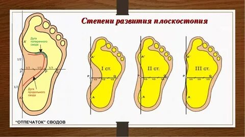 Характеристика плоскостопия москва