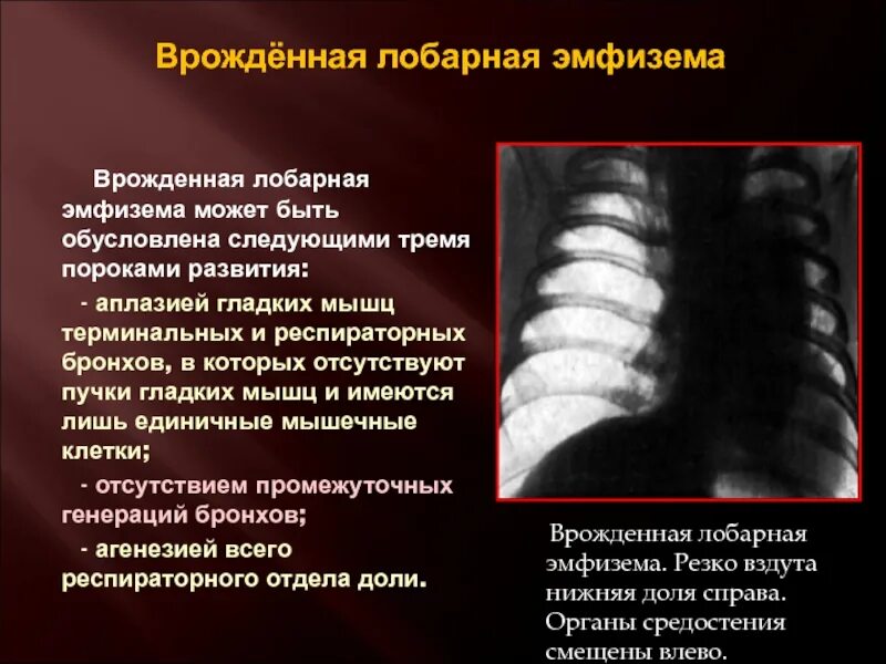Порок легкого у ребенка. Пороки развития органов дыхания. Порок легкого у ребенка. Пороки развития легких рентген. Агенезия аплазия гипоплазия легких.