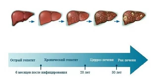 Сколько живут с гепатитом печени