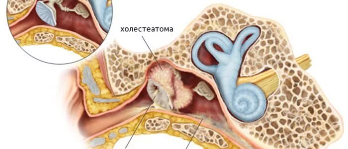 Холестеатома барабанной полости. Мезотимпанит барабанная перепонка. Тимпанопластика холестеатома. Холестеатома слуховых косточек. Операция на среднем ухе