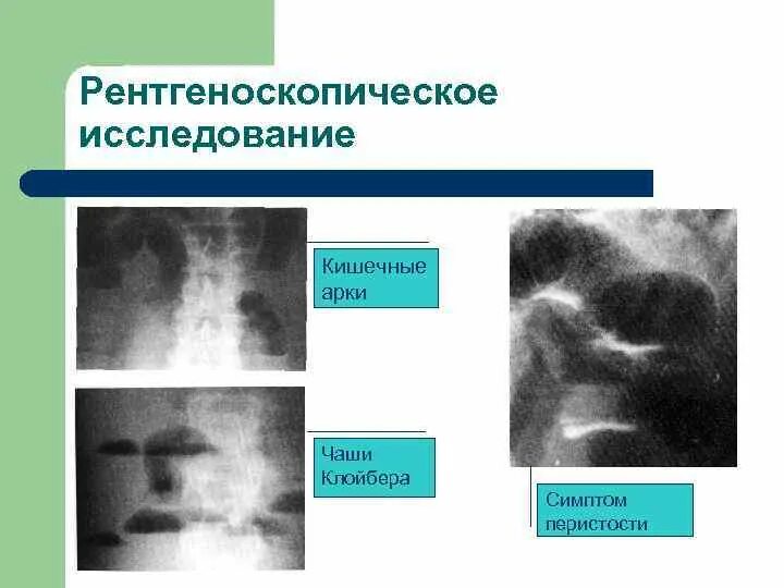 Чаши клойбера на рентгенограмме. Толстокишечная непроходимость чаши клойбера рентген. Чаши клойбера на рентгенограмме при тонкокишечной непроходимости. Свободный газ и чаши клойбера. Кишечная непроходимость чаши клойбера.