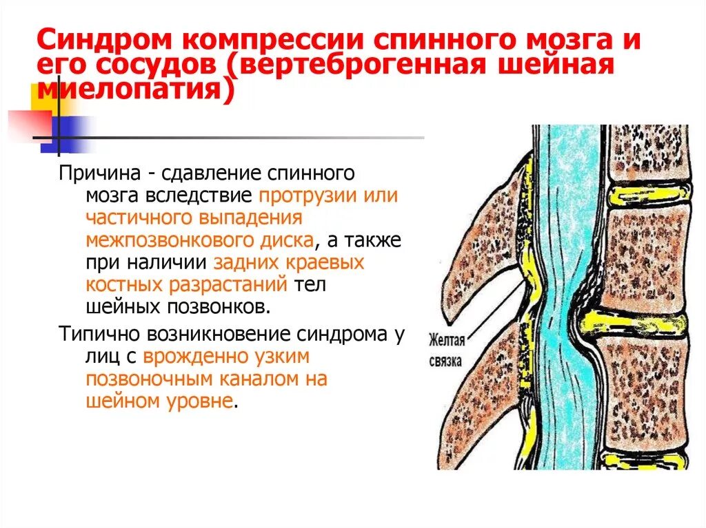 Компрессия спинного мозга симптомы. Синдром компрессии спинного мозга. Признаки компрессии спинного мозга. Миелопатии спинного мозга.