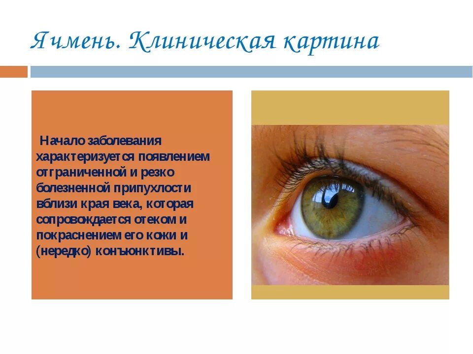 Заболевания век ячмень. Клинические проявления ячменя. Этапы развития ячменя на глазу. Этапы формирования ячменя на глазу.