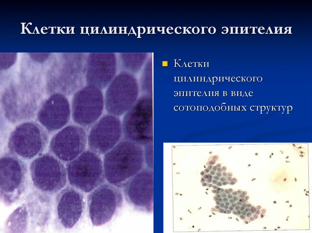 Цилиндрический эпителий цитология. Пролиферация гиперплазия цитология. Клетки цилиндрического эпителия в мазке что это такое. Шейка матки цилиндрический эпителий.