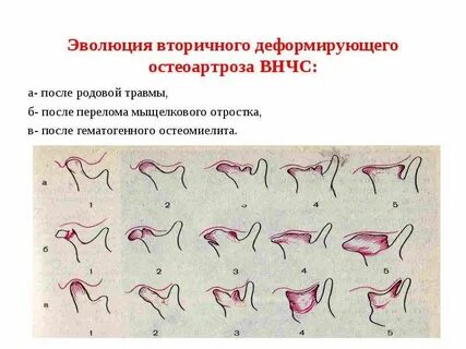 Вторичный деформирующий