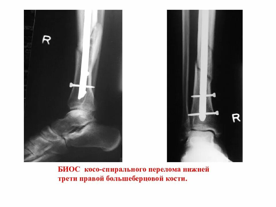 Блокируемый интрамедуллярный остеосинтез большеберцовой кости. Перелом большеберцовой кости остеосинтез. Остеосинтез перелома берцовой кости. Перелом диафиза малоберцовой кости.