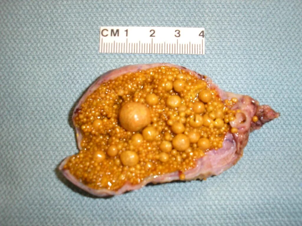 Камни желчь пузыря. Желчекаменная болезнь холестериновые камни. Мягкие холестериновые камни в желчном пузыре. Смешанные камни ЖКБ камни. Камни желчного пузыря патанатомия.