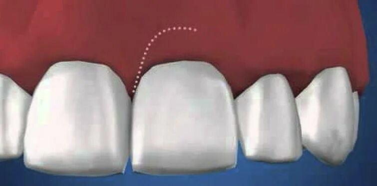 Хирургическое удлинение коронковой части зуба. Клиническое удлинение коронки зуба. Удлинение клинической коронки. Хирургическое удлинение коронки зуба. Удлинить коронку