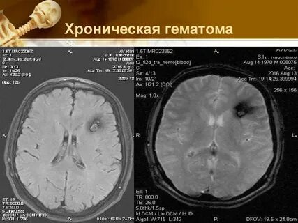 Внутримозговая гематома мрт