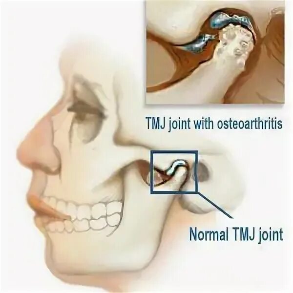 Почему может болеть челюсть. Мышечная дисфункция ВНЧС. Челюстью(дисфункция ВНЧС). Дисфункция височно-нижнечелюстного сустава.