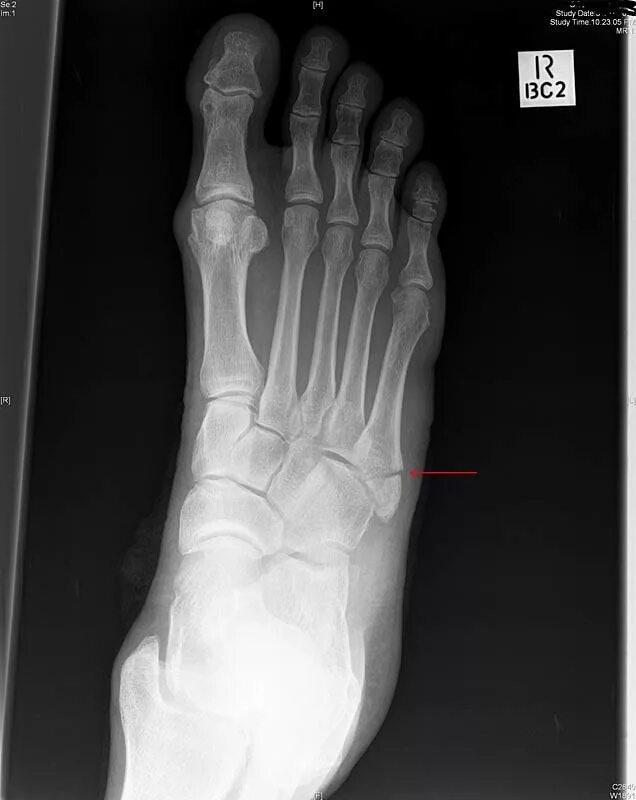 Jones Fracture - FootEducation Avulsion fracture, Jones fracture, Metatarsal fra