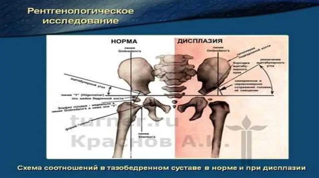 Дисплазия т б сустава. Рентген тбс здорового человека. Снимки дисплазия тазобедренного сустава. Пателофемолярное сочленение дисплазия. Дисплазия тазобедренного сустава на рентгенограмме.