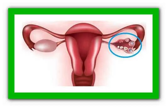 Функциональная киста яичника. Киста яичника народные средства.