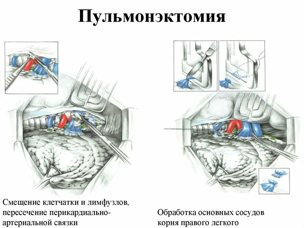 Лобэктомия что это. Пульмонэктомия лобэктоми. Резекция легких и пневмонэктомия. Лобэктомия и пневмонэктомия. Сегментэктомия лобэктомия.