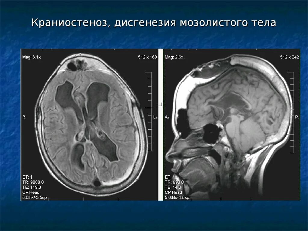 Аномалия мозолистого тела. Мозолистое тело головного мозга кт. Премаксиллярная агенезия. Мозолистое тело головного мозга кт. Врожденная аномалия мозолистого тела что это такое.
