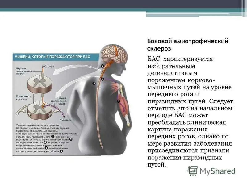 синдром бокового амиотрофического склероза симптомы. боковой латеральный амиотрофический склероз. клинические проявления бас. боковое амниотрофичекий склероз. боковое остофически склероз.