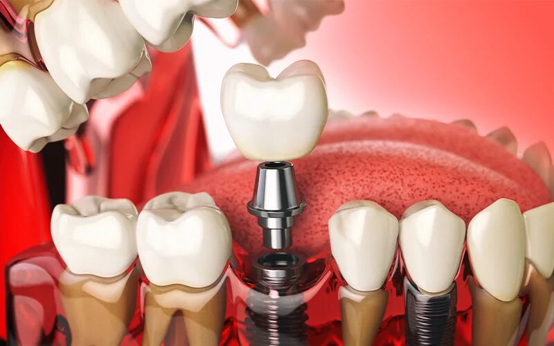 Протезирование что входит. Самые крутые импланты зубов. Двухэтапная имплантация. Кортекс система имплантов. Внутрикостная дентальная имплантация.