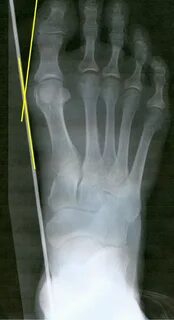 Fractura pedis transversa
