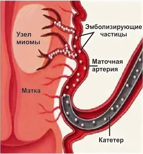 Эма миомы матки
