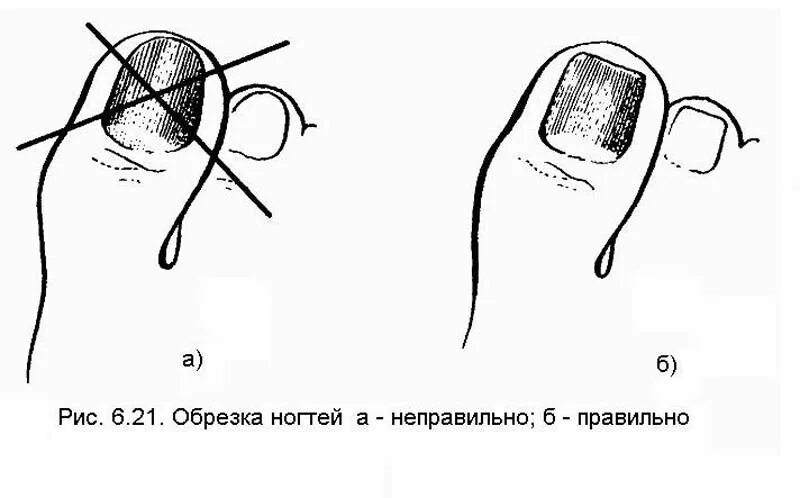 Как подстригать ноготь большого пальца ноги. Как правильно отрезать ногти. Правильная обрезка ногтей на ногах. Как правильно отрезать ногти на ногах. Как правильно стричь ногти.