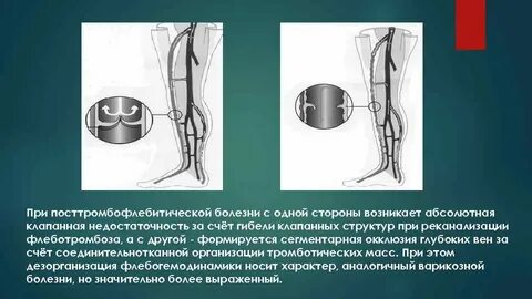 Недостаточность венозного клапана