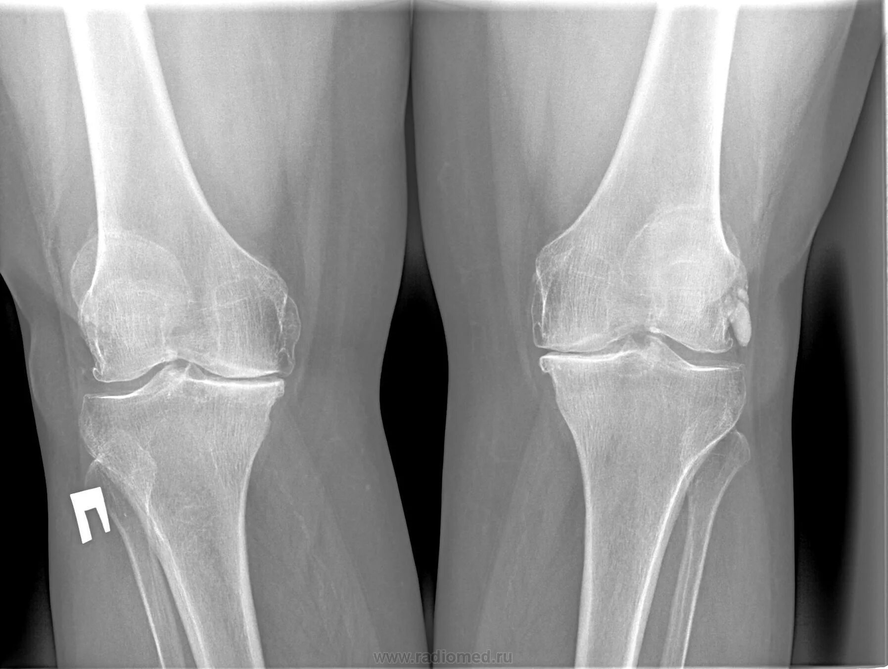 Суставной мыщелок. Синовит коленного суставаренген. Перелом надмыщелка бедренной кости. Перелом мыщелка коленного сустава рентген. Рентгоен анатомия коленного сустава.