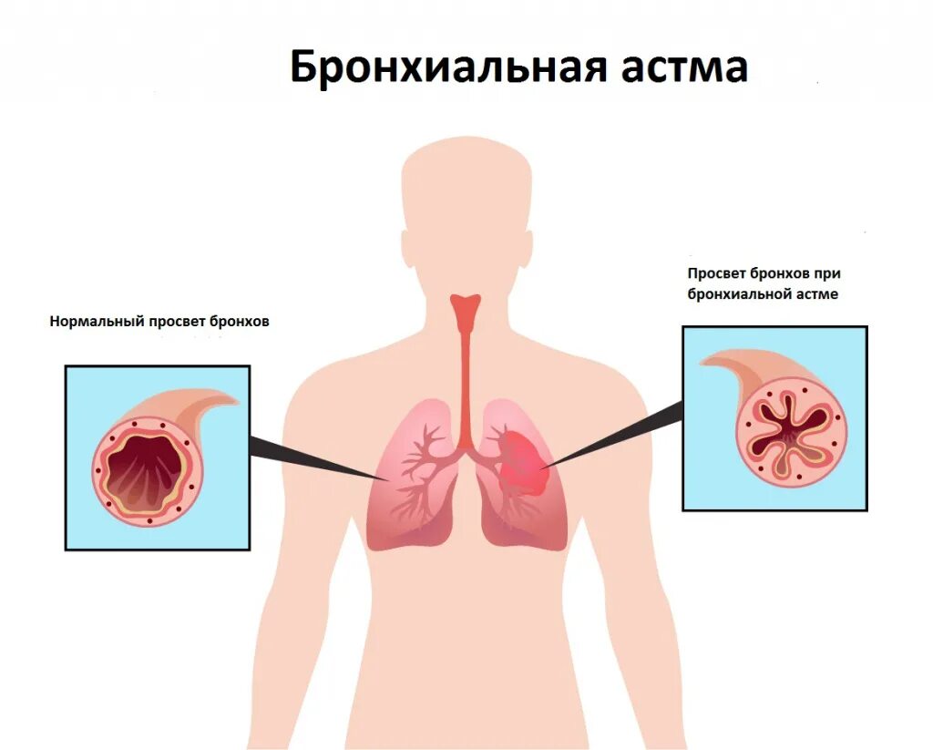 Почему часто кашляешь. Бронхиальная астма. Бронхиальная астма легкие.