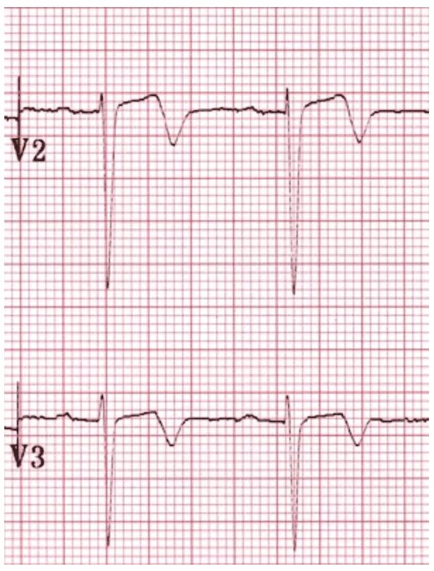 синдром велленса на экг. синдром велленса и паттерн де винтера. Wellens на экг. велленса синдром велленса на экг. паттерн велленса экг.