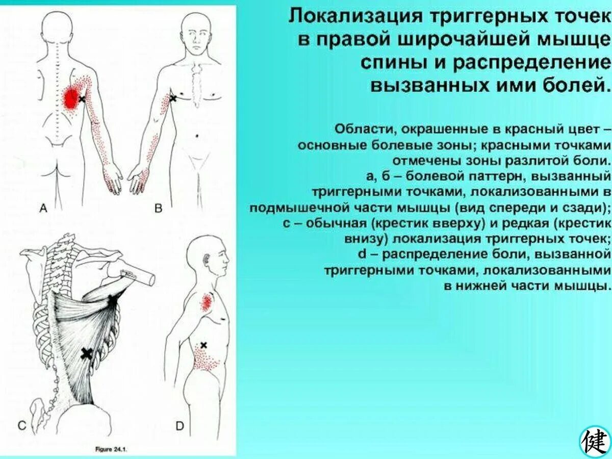 Зона поясницы. Триггерные точки широчайшей мышцы спины. Триггерные точки передней зубчатой мышцы. Триггерные точки в мышцах спины. Карта триггерных точек.