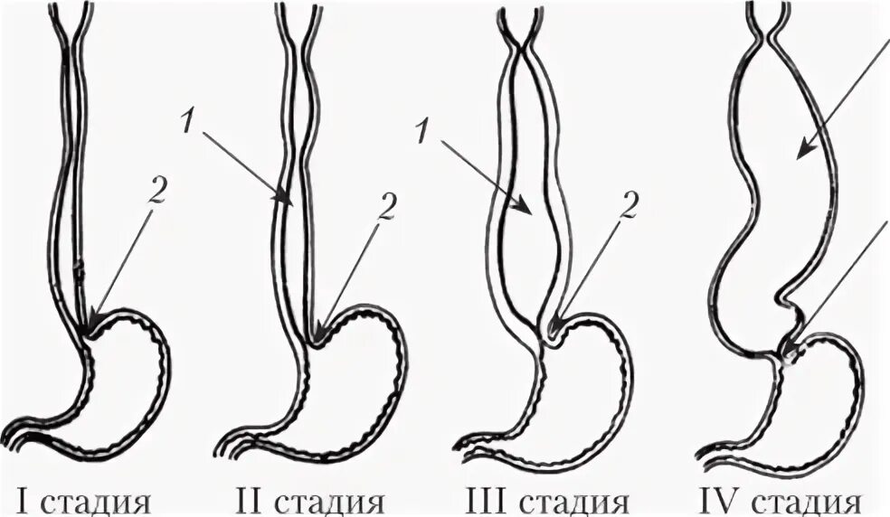 Пищевода 4 стадия. Ахалазия кардии пищевода. Классификация ахалазии пищевода. Ахалазия кардии классификация.