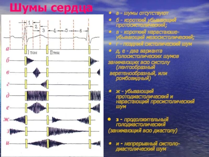 Тоны и шумы сердца. Тоны и шумы сердца пропедевтика. Шумов сердца. Шумы сердца схема. Сердечные тоны шумы