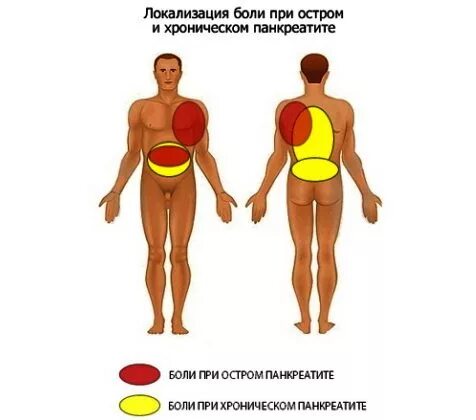 Локализация боли при панкреатите. Локализация боли при остром панкреатите. Локализация боли при хроническом панкреатите. Локализация боли при воспалении поджелудочной железы.