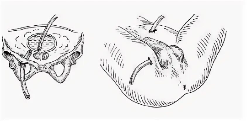 Дренирование по Буяльскому Мак Уортеру. Дренирование клетчаточных пространств таза. Дренирование таза по Буяльскому. Цистостома мочевого пузыря катетер. Операция мочевой пузырь собака