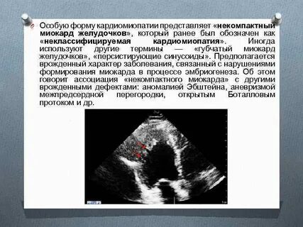 Некомпактный миокард