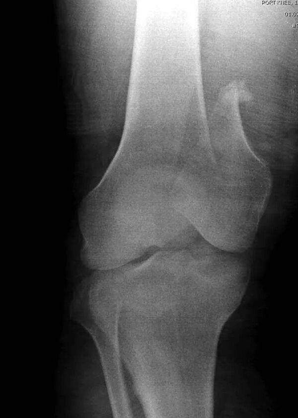 Перелом мыщелка бедренной кости рентген. Перелом мыщелков бедренной кости рентген. Перелом мыщелка бедра рентген. Перелом внутреннего мыщелка бедренной кости.
