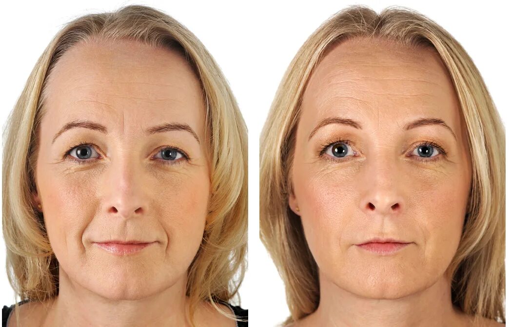Коррекция возрастных изменений. Мимические морщины носогубные. Лицо с морщинами до и после. Омоложение лица до и после. Фейслифтинг для лица.
