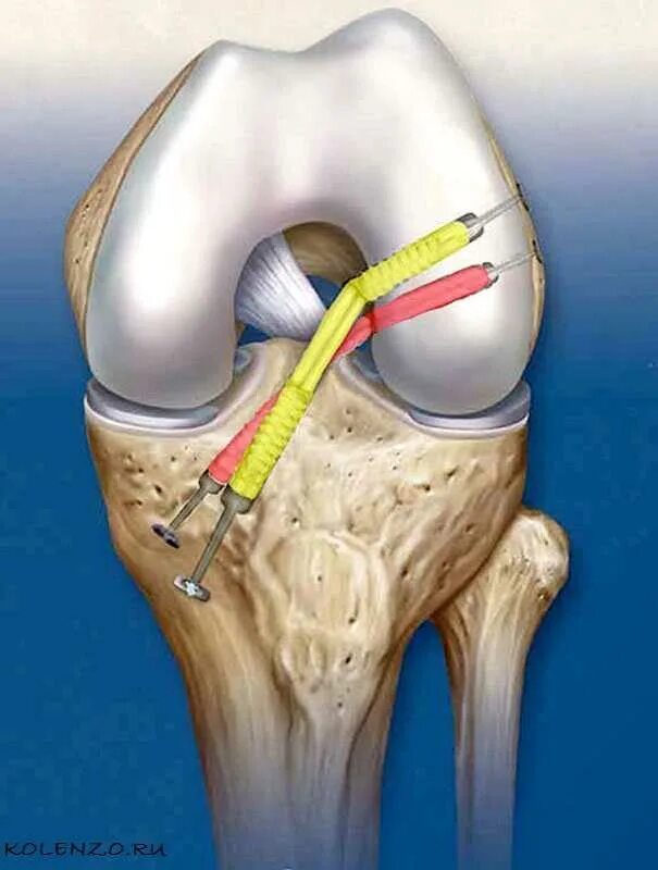 Лечение разрыва мениска коленного. ПКС (передняя крестообразная связка). Крестообразные связки коленного мениска. Артроскопическая резекция мениска. Операция пластика ПКС коленного сустава.